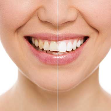 Teeth Whitening in Avon
