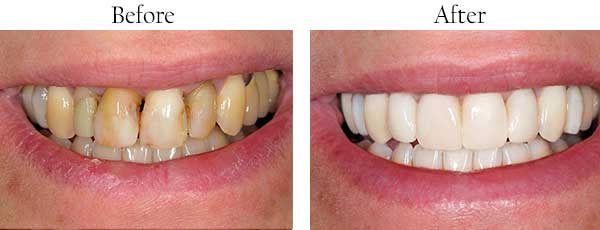 Avon Before and After Teeth Whitening 