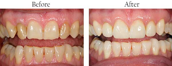 Brownsburg Before and After Invisalign
