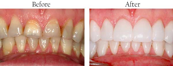 Danville Before and After Dental Implants